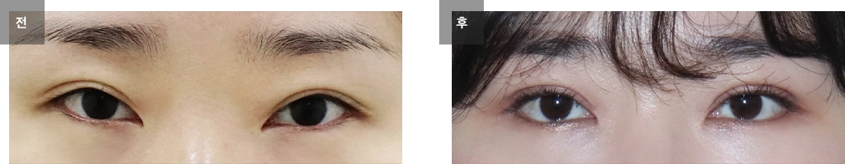 눈매교정 수술 전후사진 #2