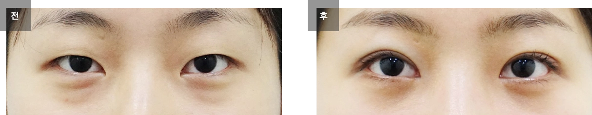 눈매교정 수술 전후사진 #4
