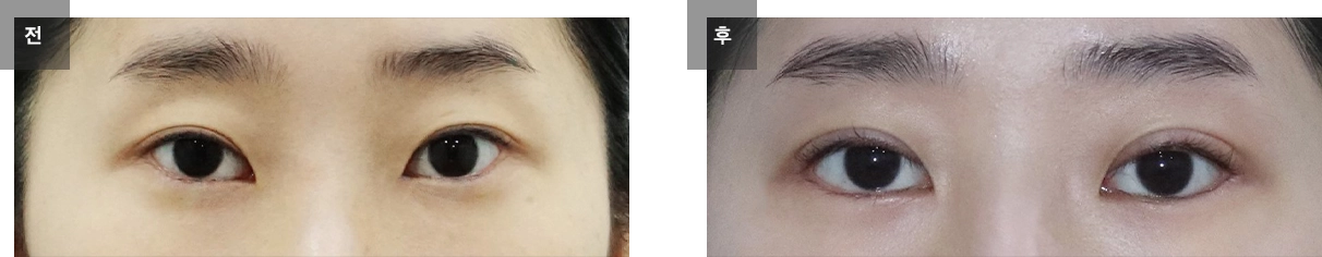 눈매교정 수술 전후사진 #7