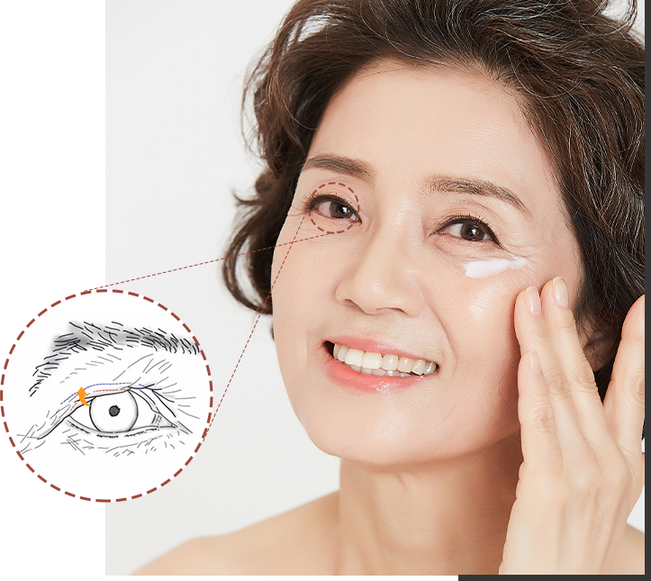 상안검 성형술