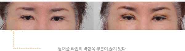 상안검 성형술 전후 사례