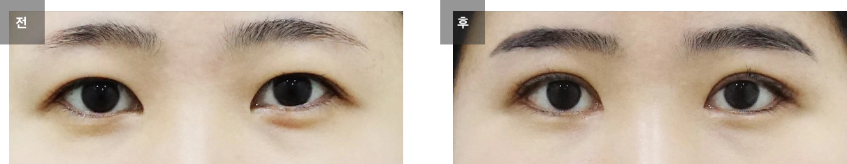 비대칭 쌍꺼풀 재수술 케이스 #1
